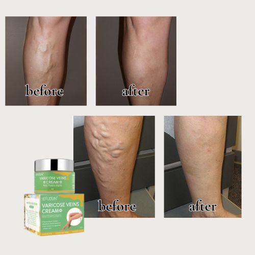 Vein Relief Cream – Comfort and Well-being for Your Legs!